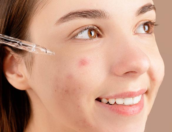 Acne Treatments Pontefract skin clinic