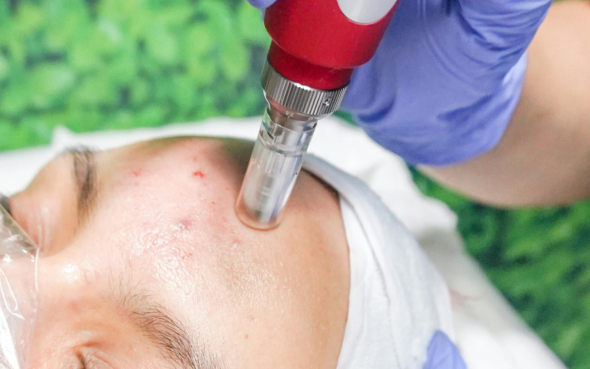 Microdermabrasion skin clinic in Pontefract Leeds Wakefield Pontefract