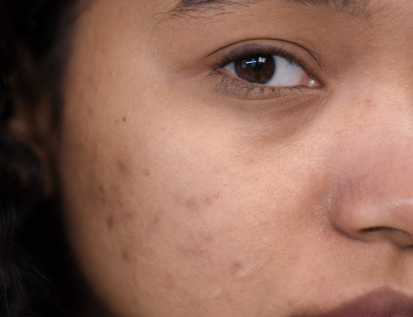 Pigmentation Treatments Pontefract skin clinic